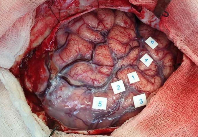 Intraoperative photo of brain mapping.png