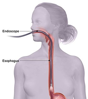 Esophageal-Endoscopy