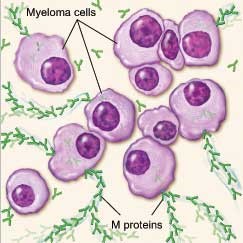 Multiple-Myeloma