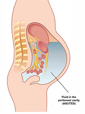 peritoneal cancer male