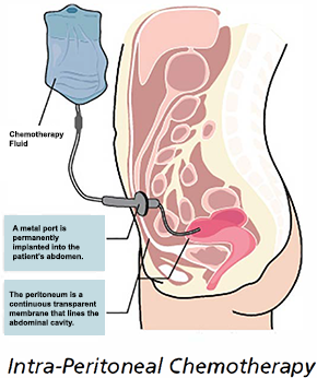 peritoneal cancer abdominal pain