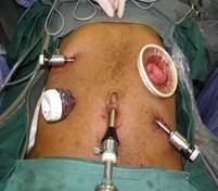 gastric-laparoscopy