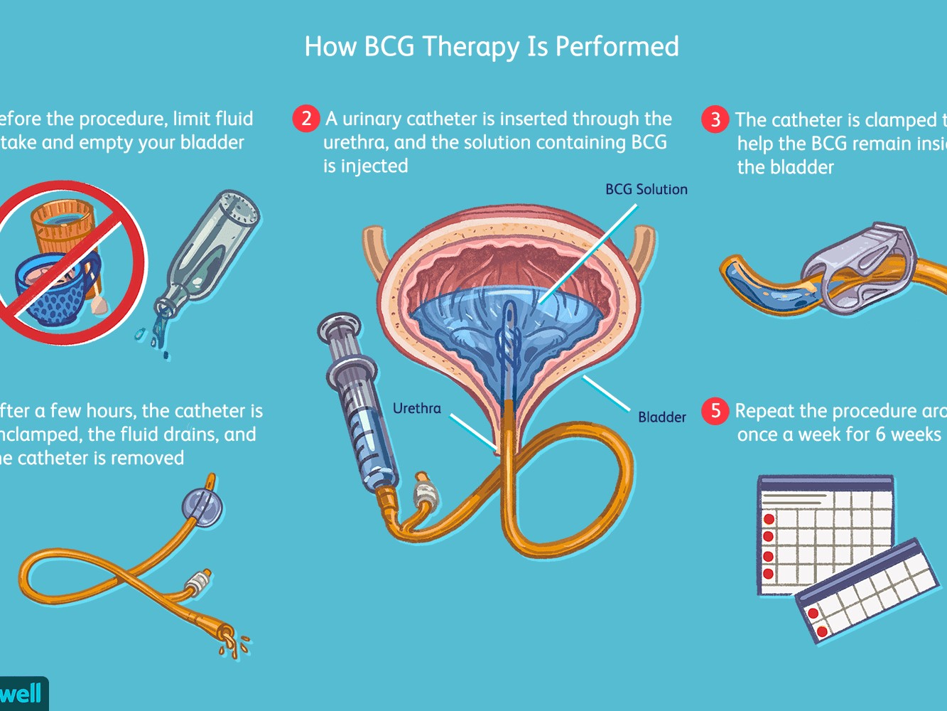 bcg therapy