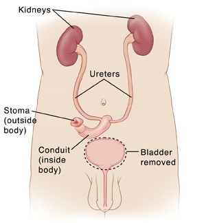 Cystectomy