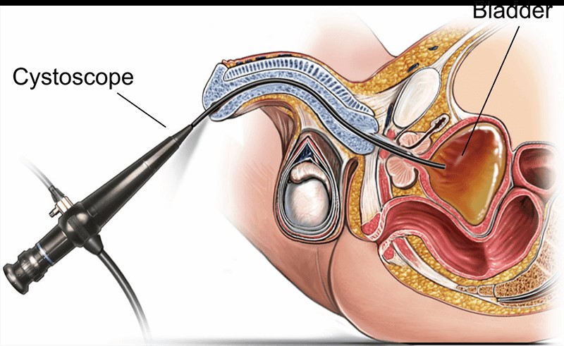 Flexible cystoscopy