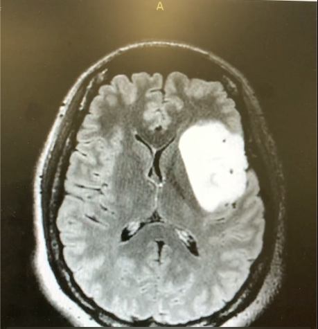 glioma