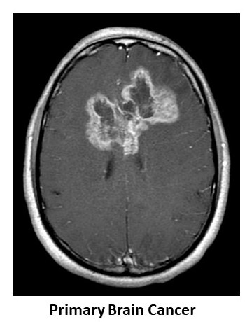 Primary Brain Cancer