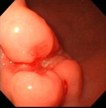 Gastric 2