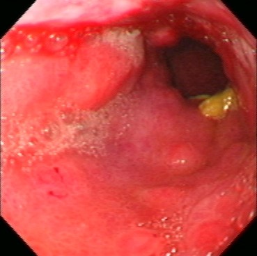 Gastric 4