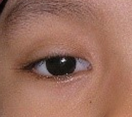 Advanced retinoblastoma after enucleation with prosthesis fitting