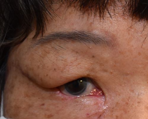 Basal Cell Carcinoma after surgical management