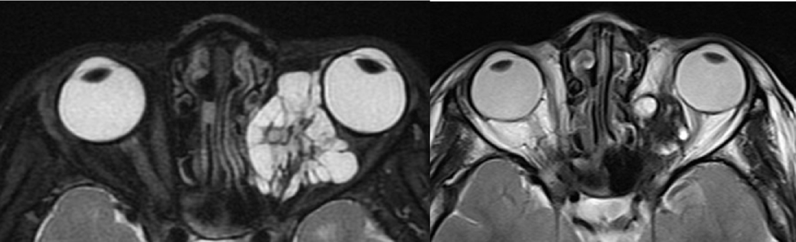 Child with Venolymphatic malformation left orbit – before and after sclerotherapy