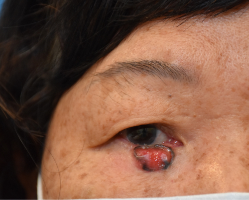 Basal cell carcinoma before