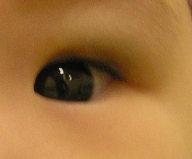 Infantile haemangioma after treatment