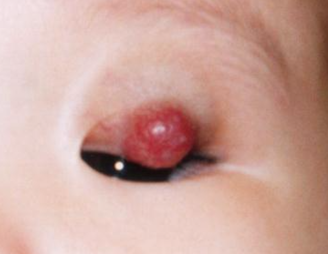 Infantile haemangioma before treatment