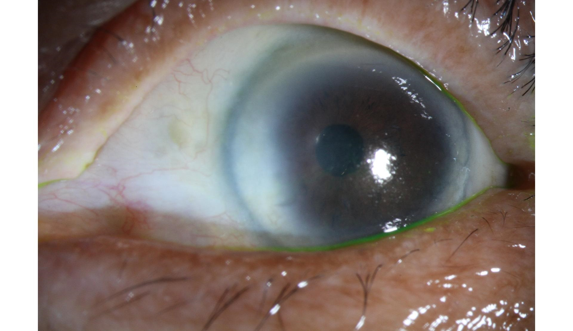 Ocular surface squamous neoplasia after treatment