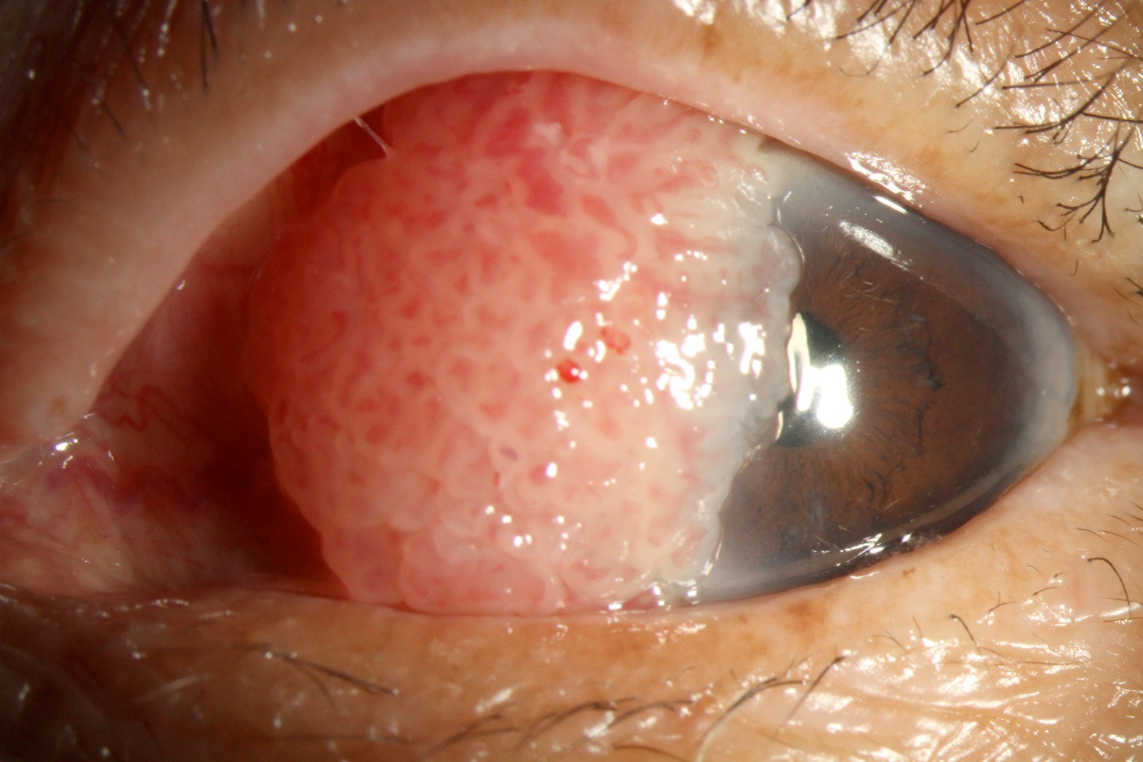 Ocular surface squamous neoplasia before treatment