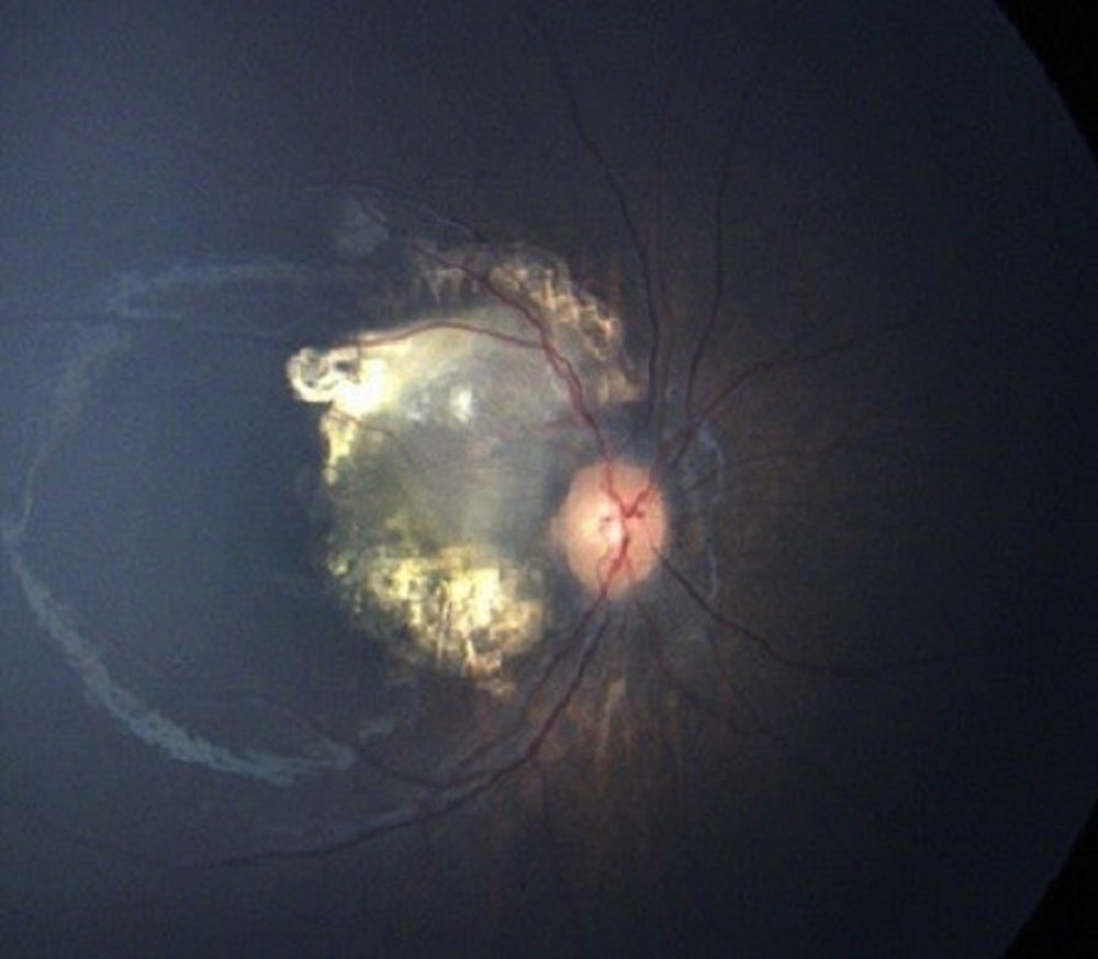 Retinoblastoma –after Intraarterial Chemotherapy