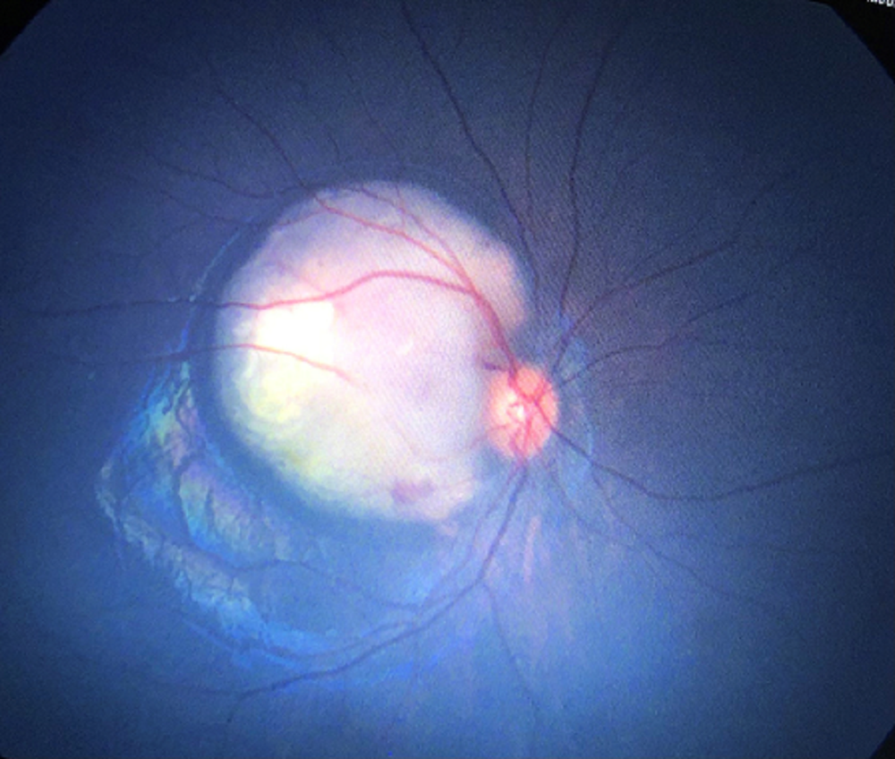 Retinoblastoma – before Intraarterial Chemotherapy