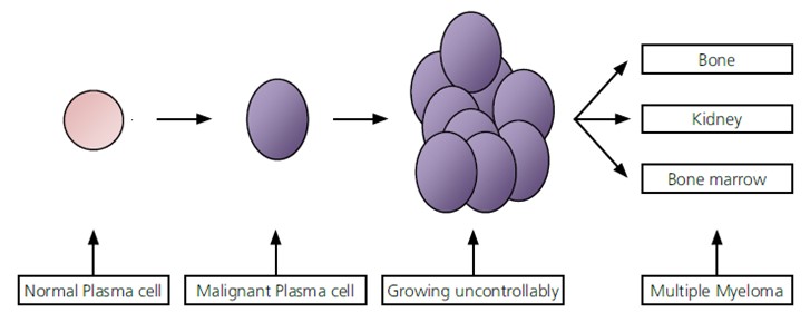 Myeloma Diagram