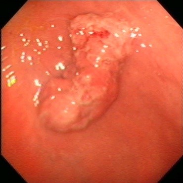 Gastric Type 1