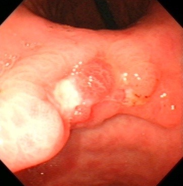 Gastric 3