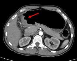 gastric-CTscan
