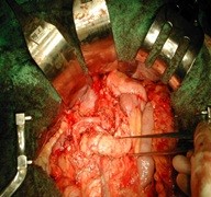 Gastric Open