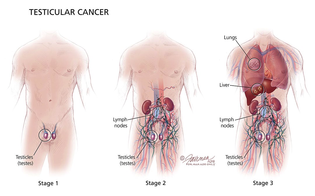 Testi cancer stages