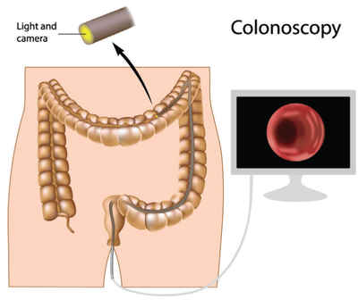 Colorectal Cancer